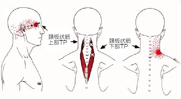 目の奥・頭の中が痛んだら頭・頚板状筋